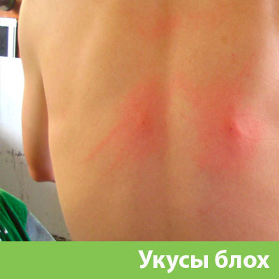 Укусы блох в Ноябрьске