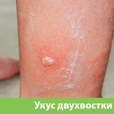 Укус двухвостки в Ноябрьске