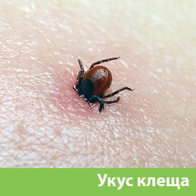 Укус клеща в Ноябрьске