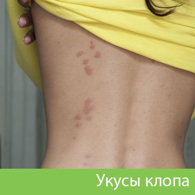 Профессиональное уничтожение клопов в Ноябрьске